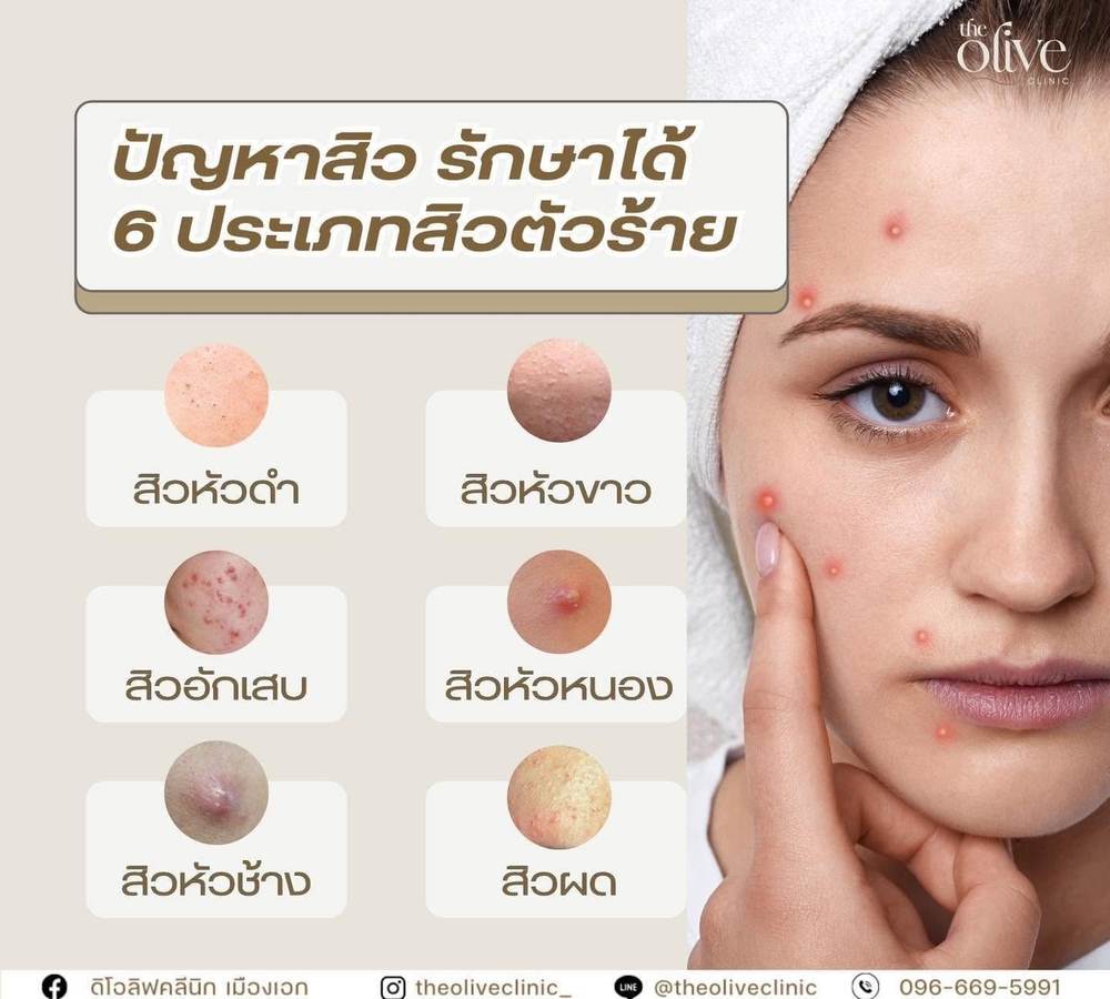 ปัญหาสิว ดูแลได้ 6 ประเภทสิวตัวร้าย