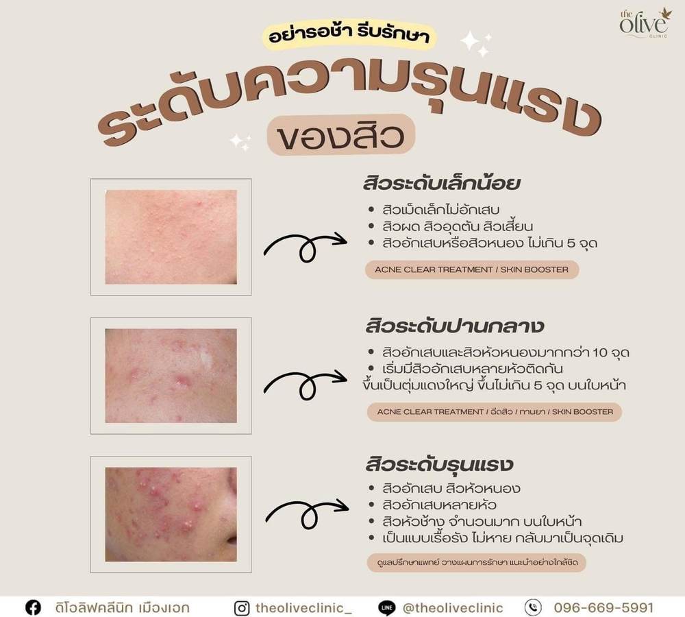 ระดับความรุนแรงของสิว เล็กน้อย ปานกลาง รุนแรง