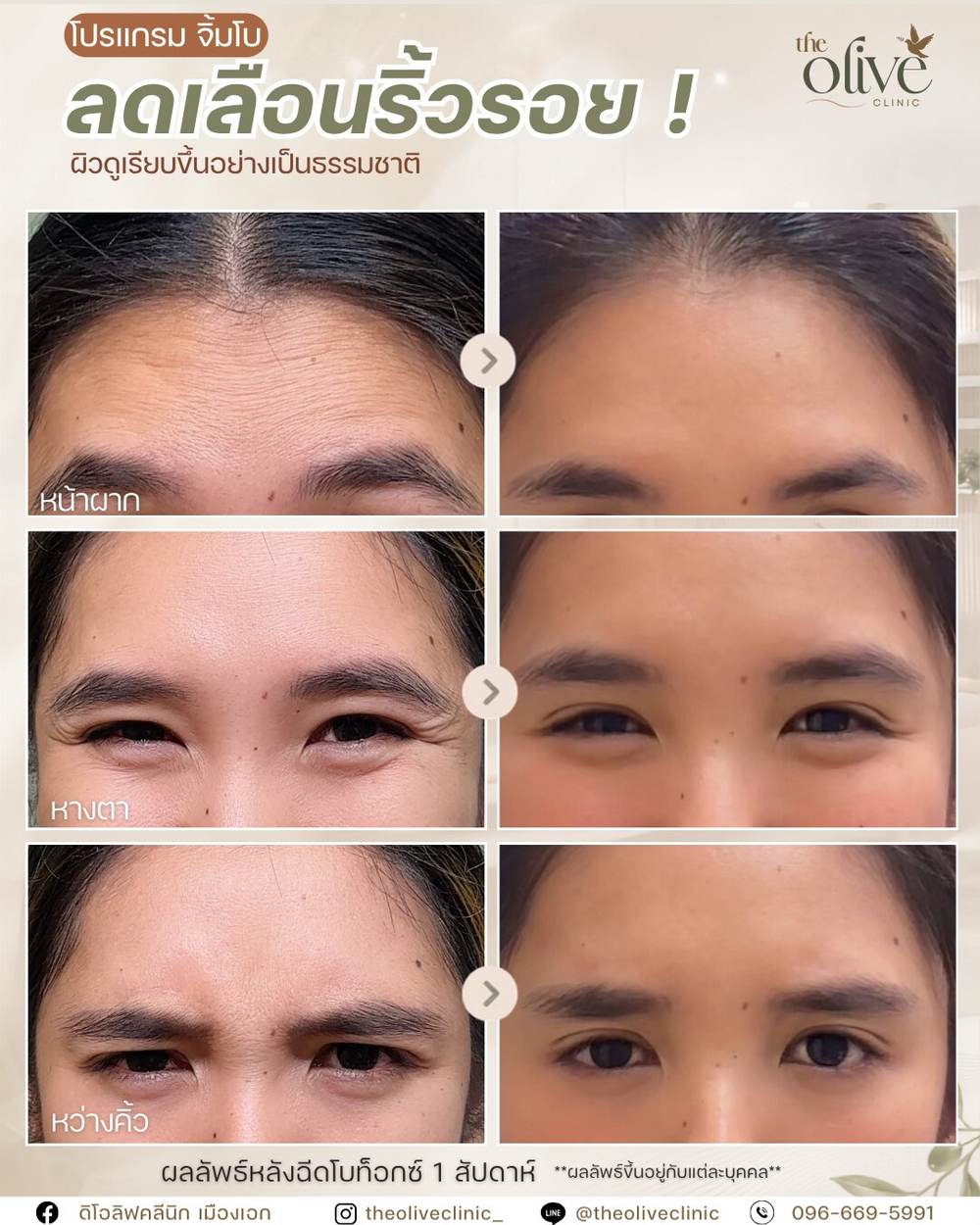 ผลลัพธ์ลดเลือนริ้วรอยหลังทำโบท็อกซ์ หน้าผาก หว่างคิ้ว หางตา
