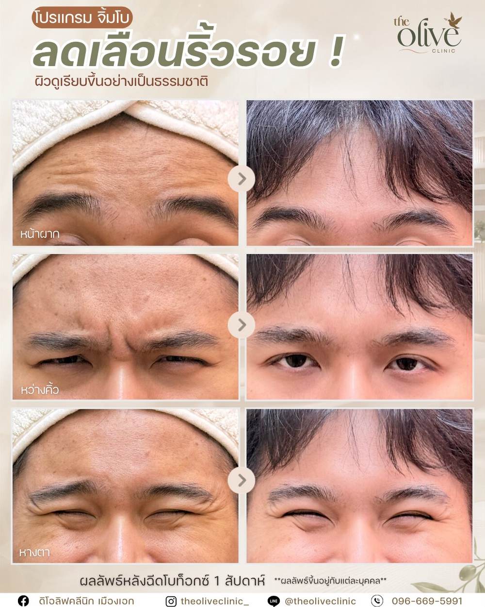 ผลลัพธ์ลดเลือนริ้วรอยหลังทำโบท็อกซ์ หน้าผาก หว่างคิ้ว หางตา