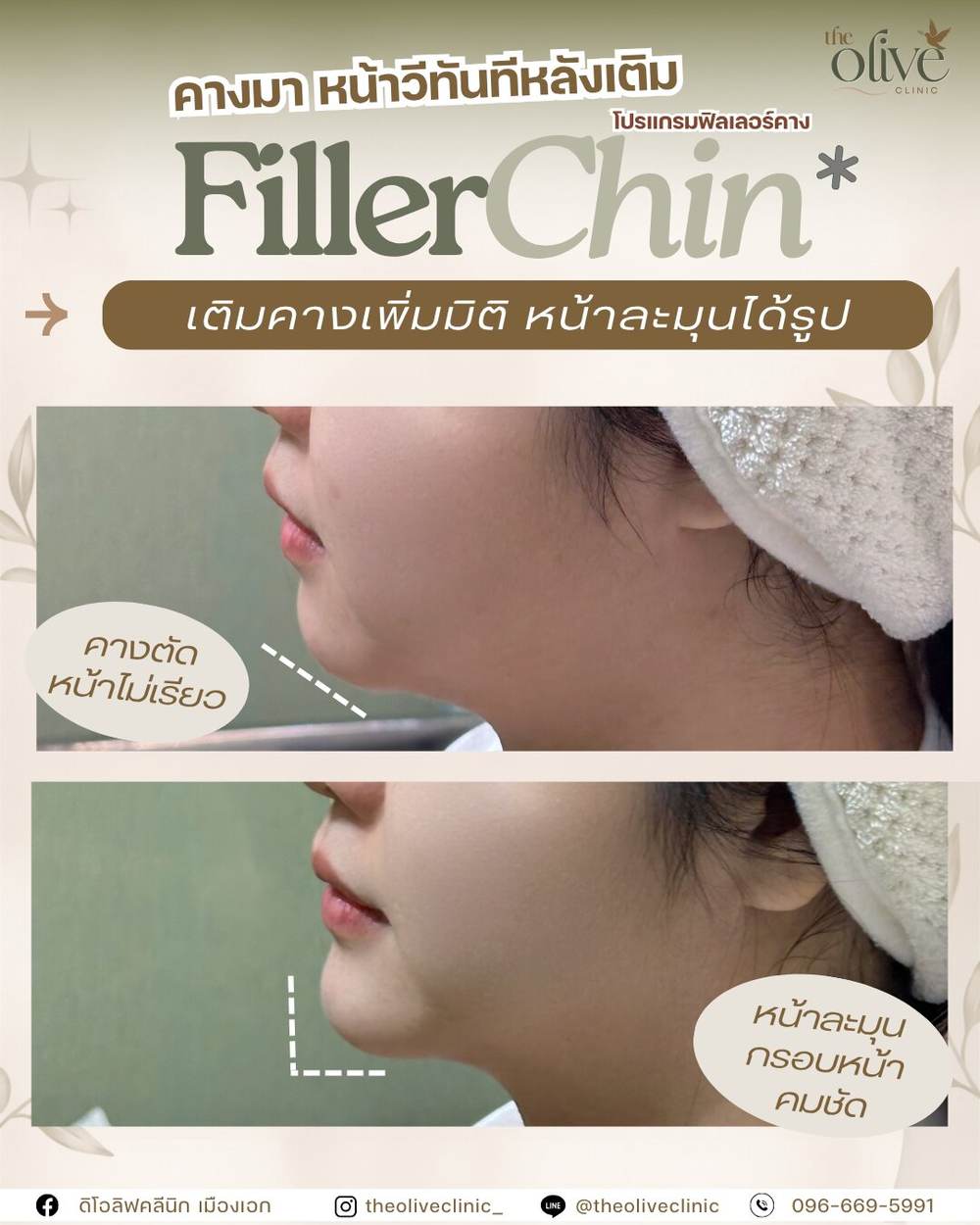 Filler Chin คางมา หน้าวีทันทีหลังเติม