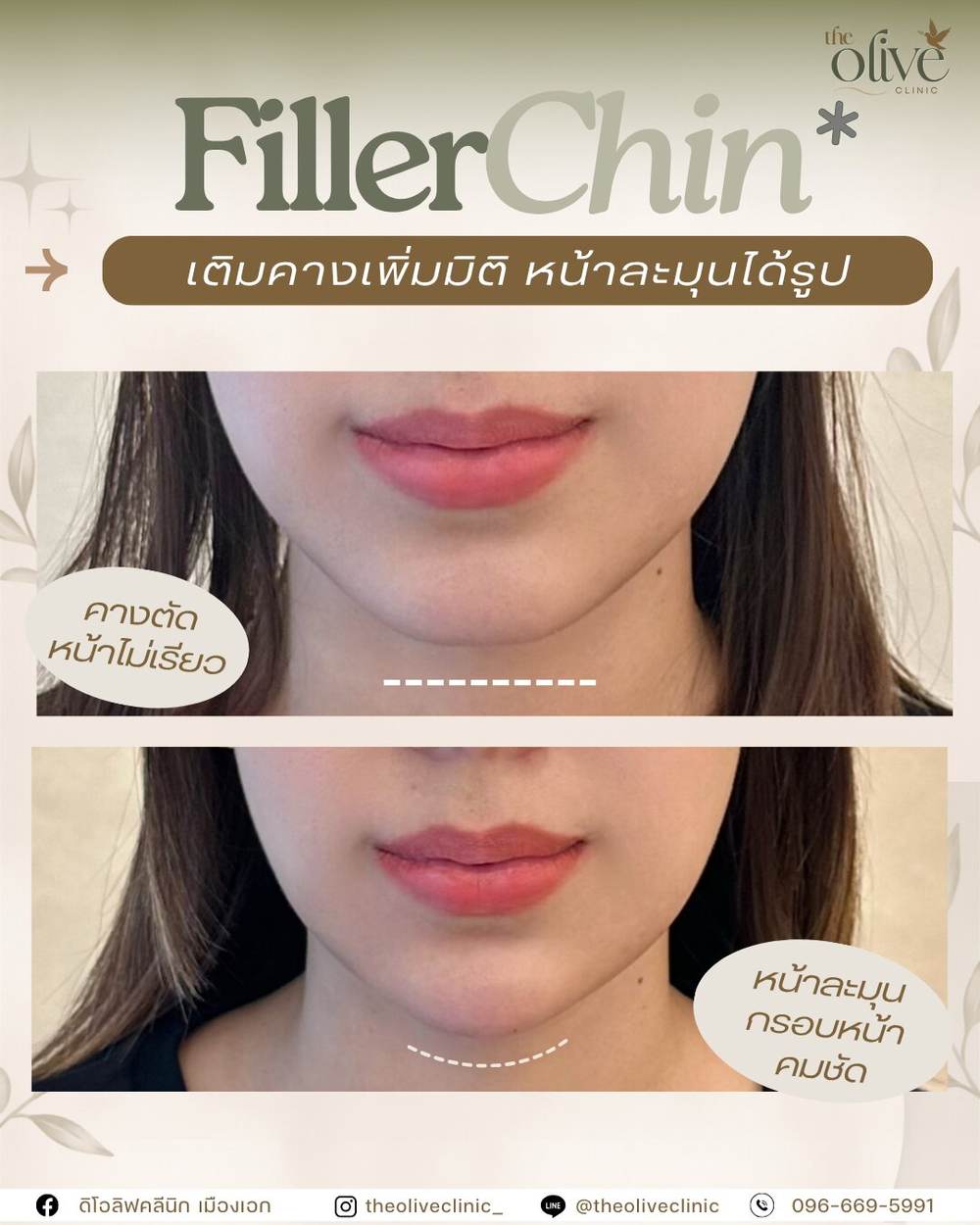 Filler Chin เติมคางเพิ่มมิติ หน้าละมุนได้รูป