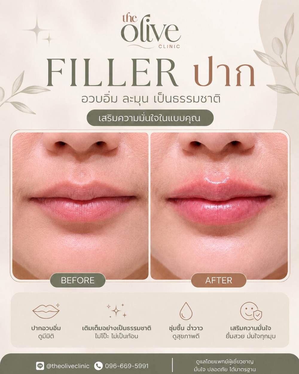 Filler ปาก อวบอิ่ม ละมุน เป็นธรรมชาติ