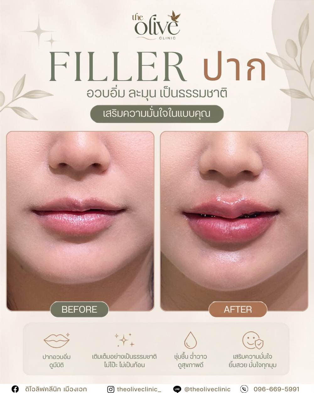 Filler ปาก รีวิวก่อนหลัง