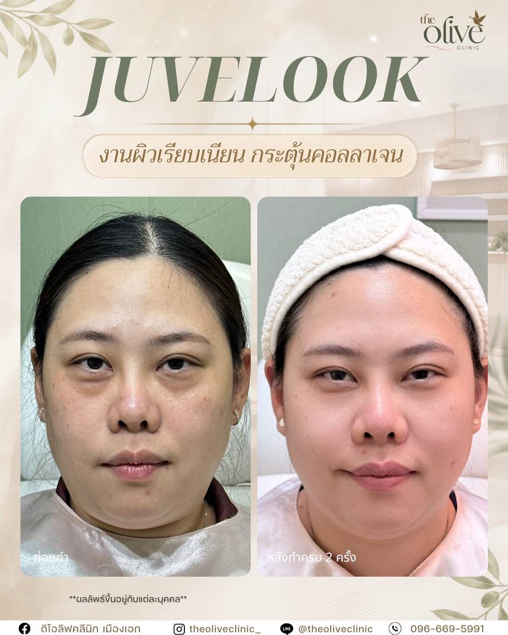 Juvelook รีวิวจริง ก่อนทำ และหลังทำครบ 2 ครั้ง