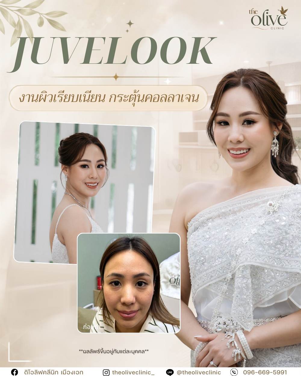 Juvelook รีวิวจริง งานผิวเรียบเนียน กระตุ้นคอลลาเจน