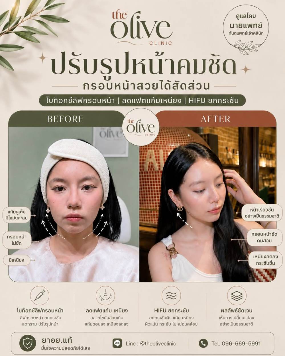 รีวิวปรับรูปหน้าคมชัด โบท็อกซ์ลิฟกรอบหน้า ลดแฟตแก้มเหนียง HIFU ยกกระชับ
