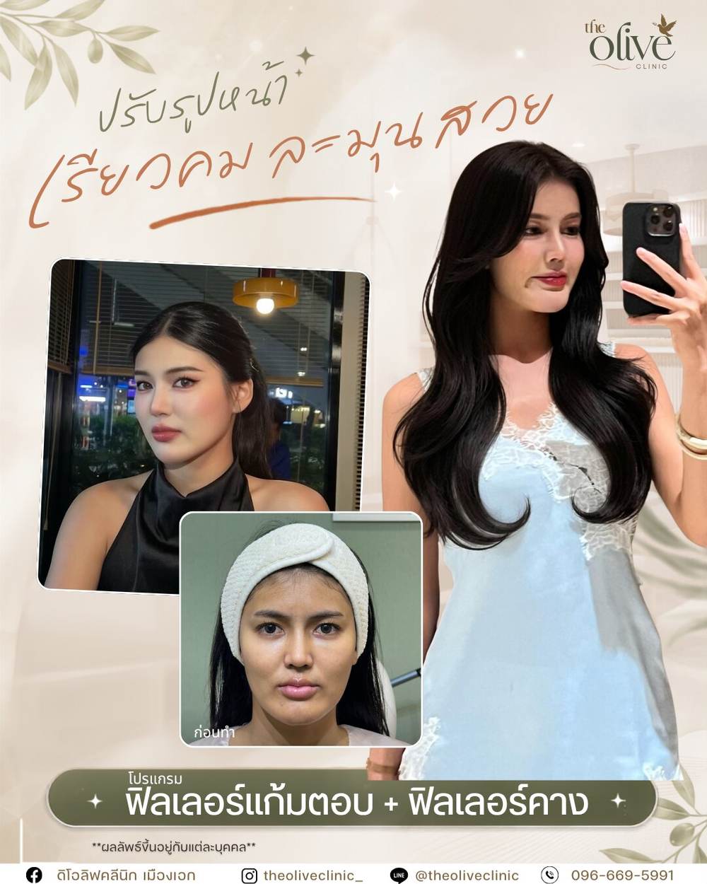 รีวิว Filler แก้มตอบ และ Filler คาง
