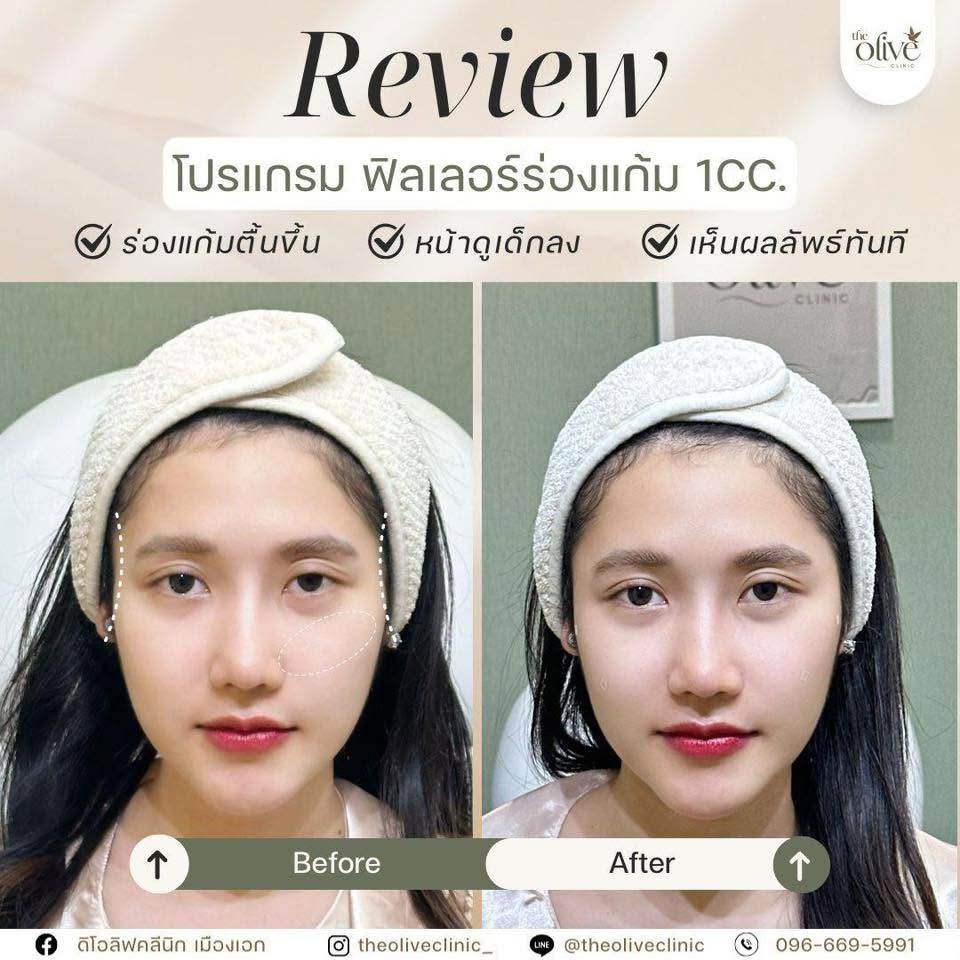 รีวิว Filler ร่องแก้ม 1CC.