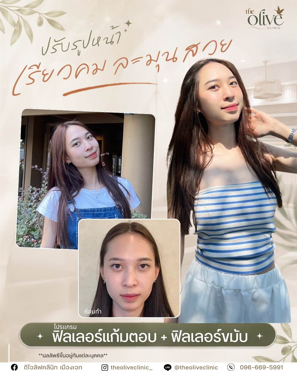 รีวิว Filler แก้มตอบ และ Filler ขมับ