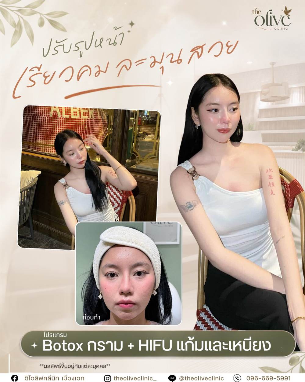 รีวิว Botox กราม และ HIFU แก้มและเหนียง