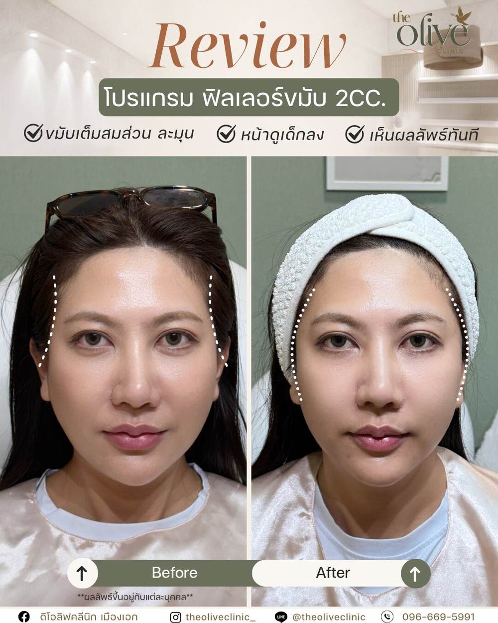 รีวิว Filler ขมับ 2CC.