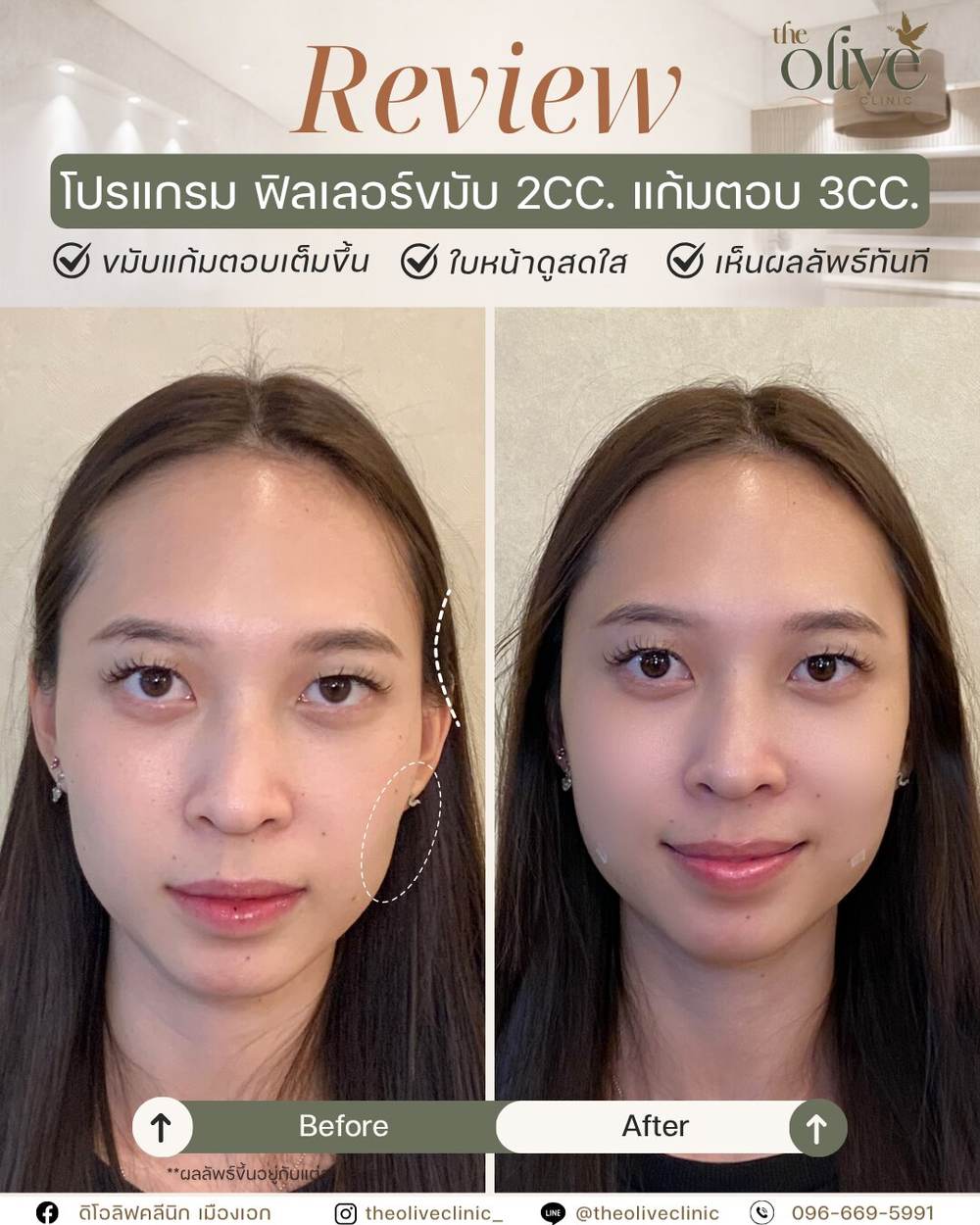 รีวิว Filler ขมับ 2CC. แก้มตอบ 3CC.