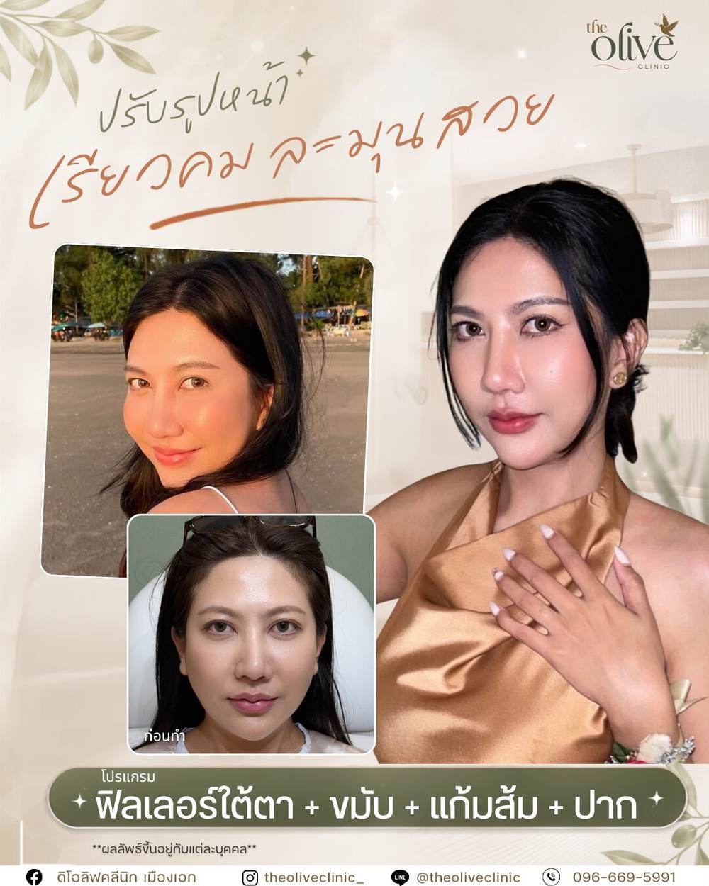 รีวิว Filler ใต้ตา ขมับ แก้มส้ม ปาก