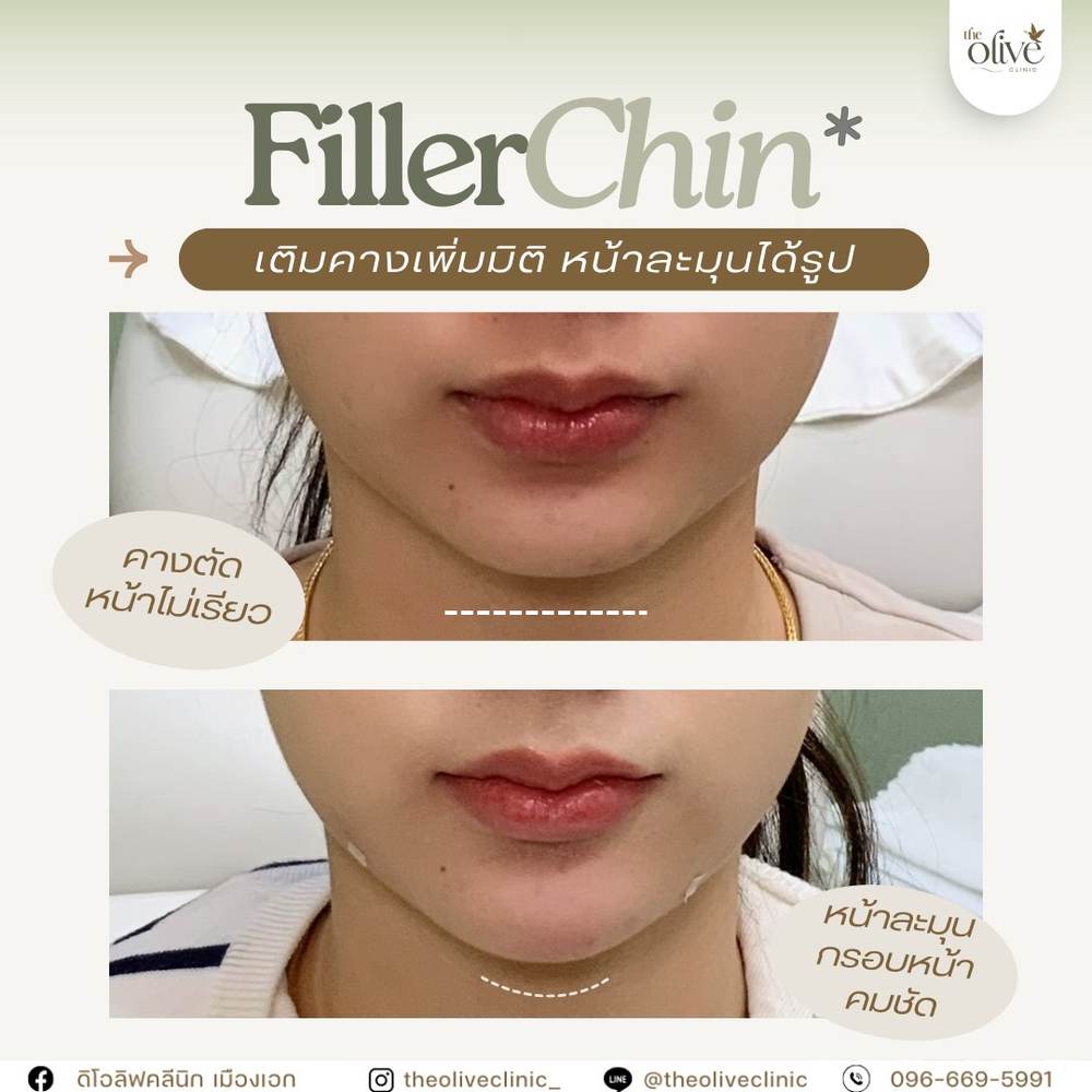 รีวิว Filler คาง ก่อนหลัง The Olive Clinic