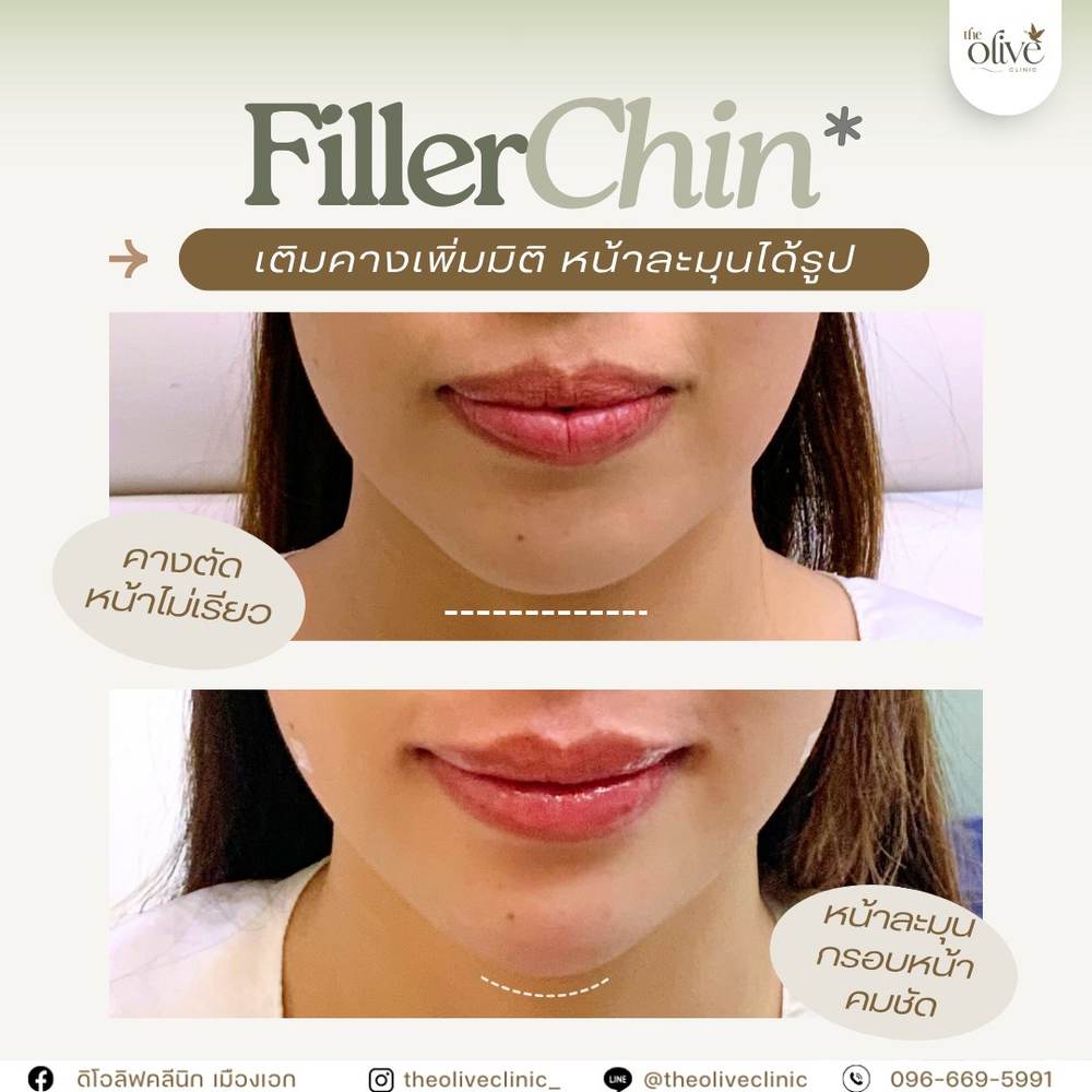 รีวิว Filler คาง ก่อนหลัง The Olive Clinic