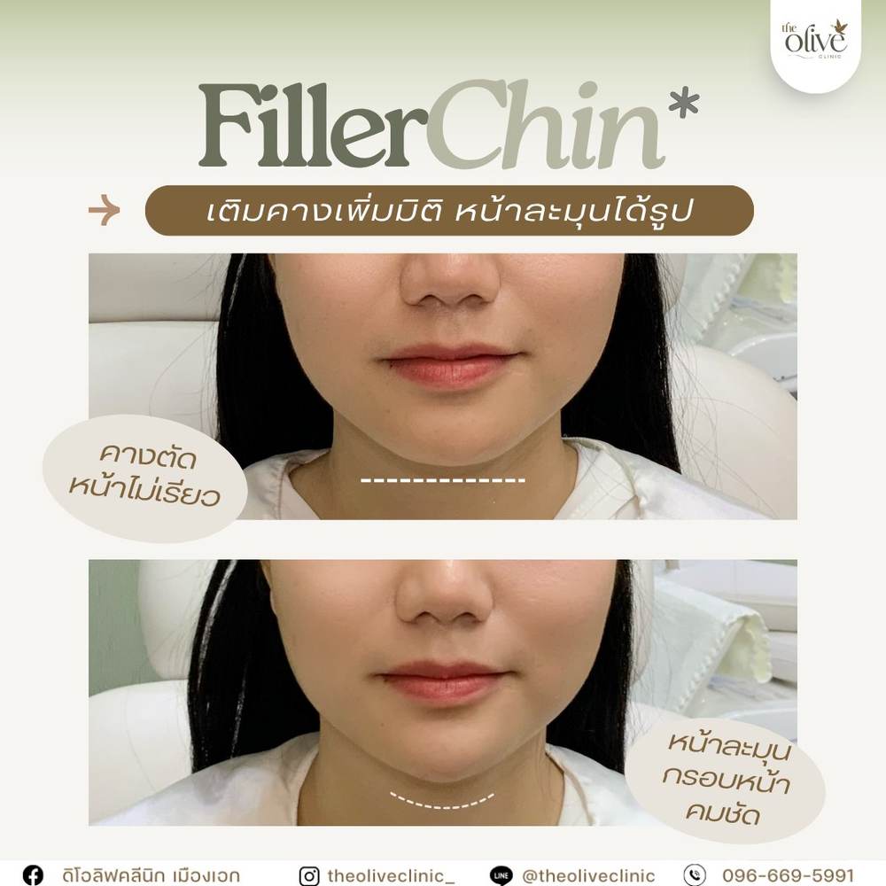 รีวิว Filler คาง ก่อนหลัง The Olive Clinic
