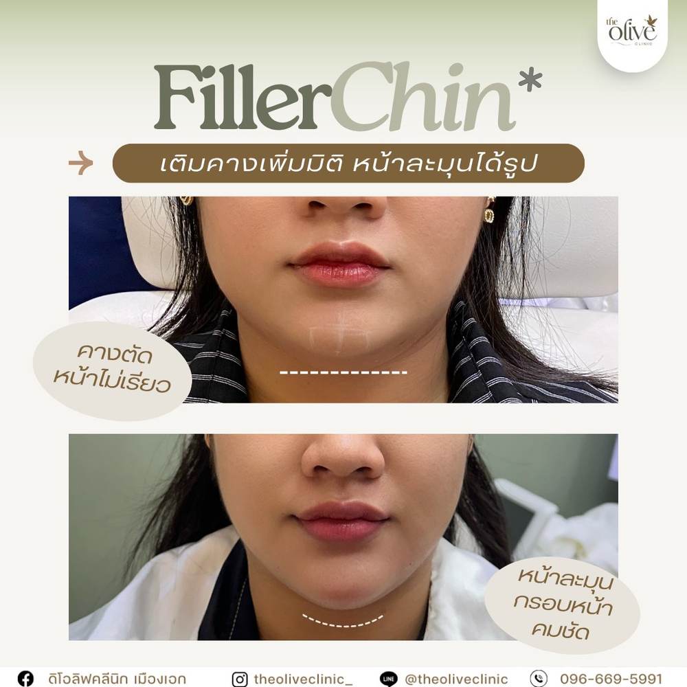 รีวิว Filler คาง ก่อนหลัง The Olive Clinic