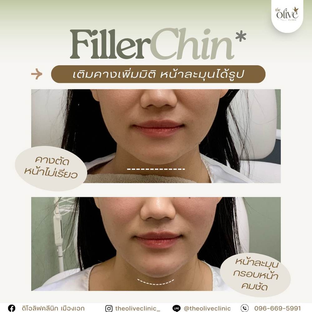 รีวิว Filler คาง ก่อนหลัง The Olive Clinic
