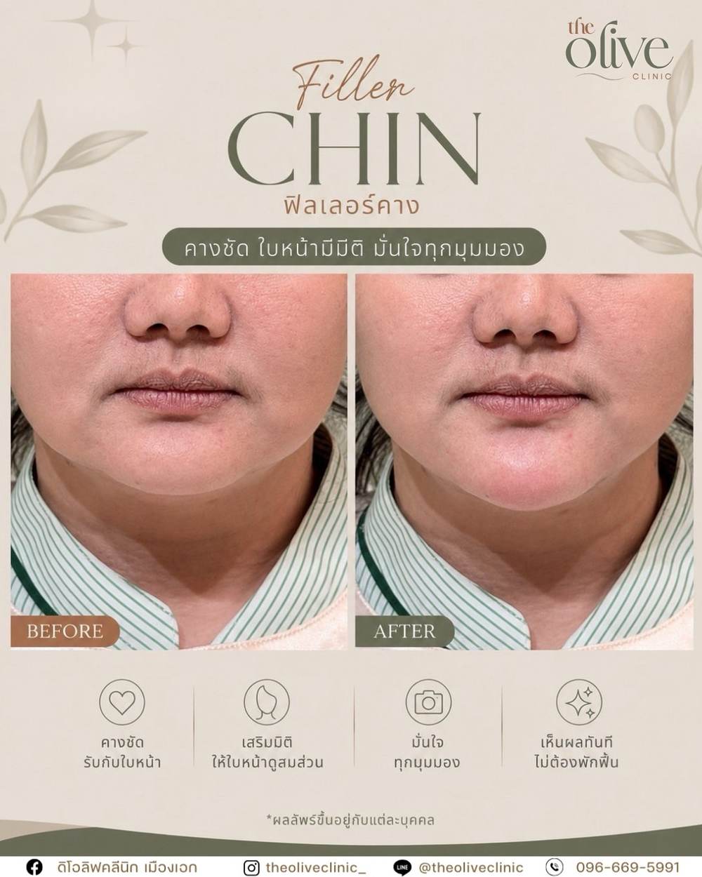รีวิว Filler คาง คางชัด ใบหน้ามีมิติ The Olive Clinic