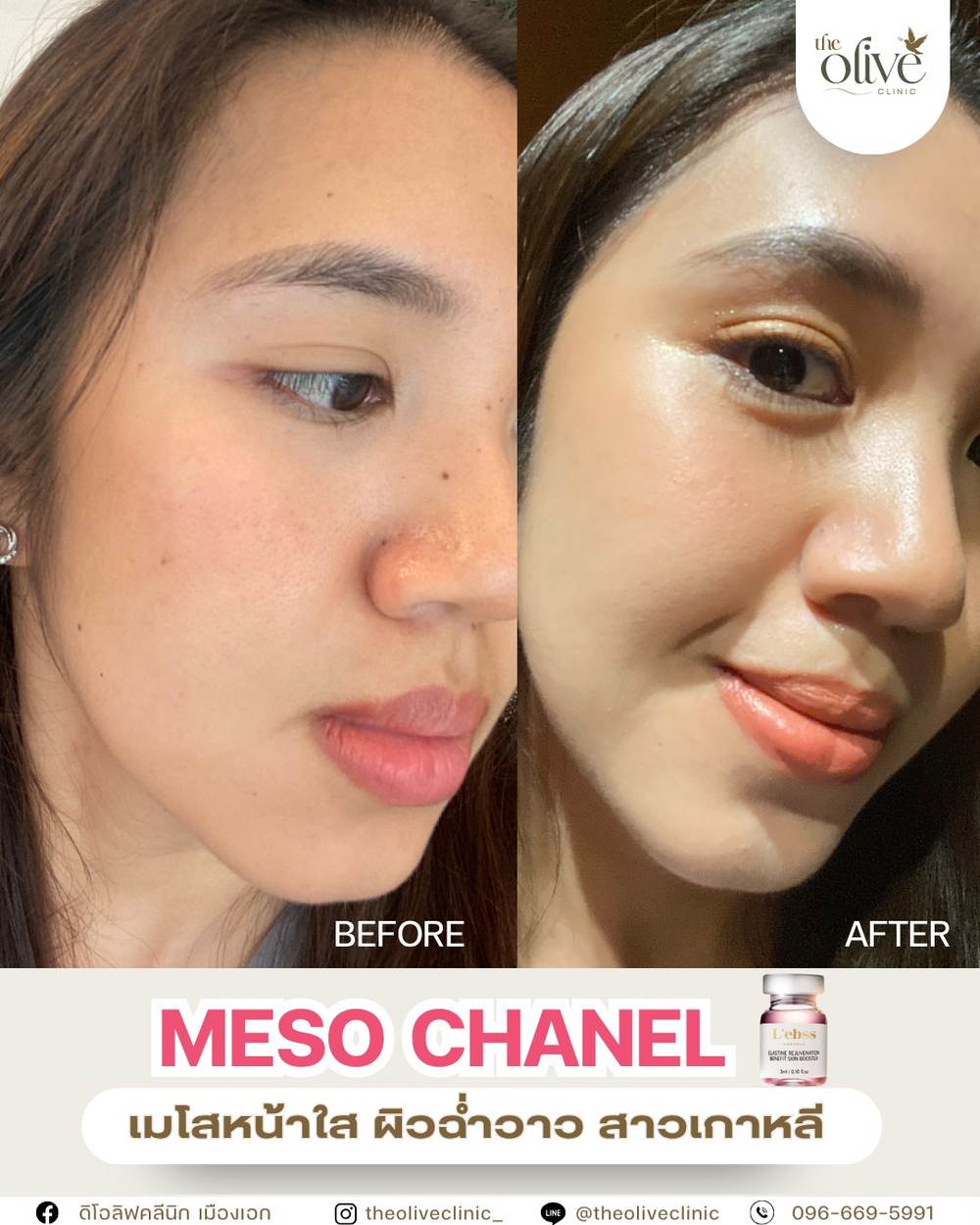 รีวิว Meso Chanel เมโสหน้าใส ผิวฉ่ำวาว The Olive Clinic