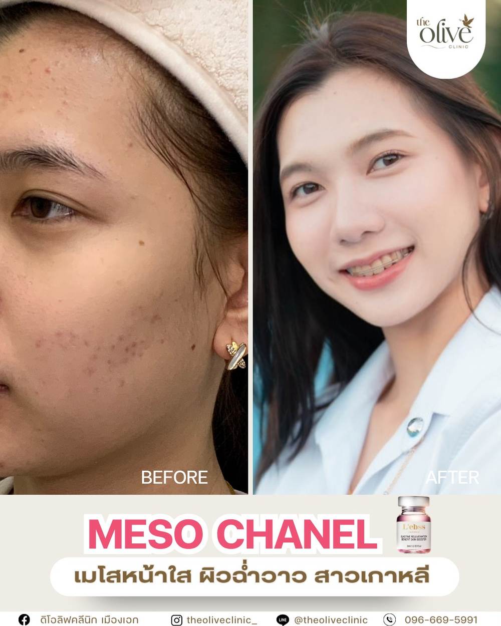 รีวิว Meso Chanel เมโสหน้าใส ผิวฉ่ำวาว The Olive Clinic