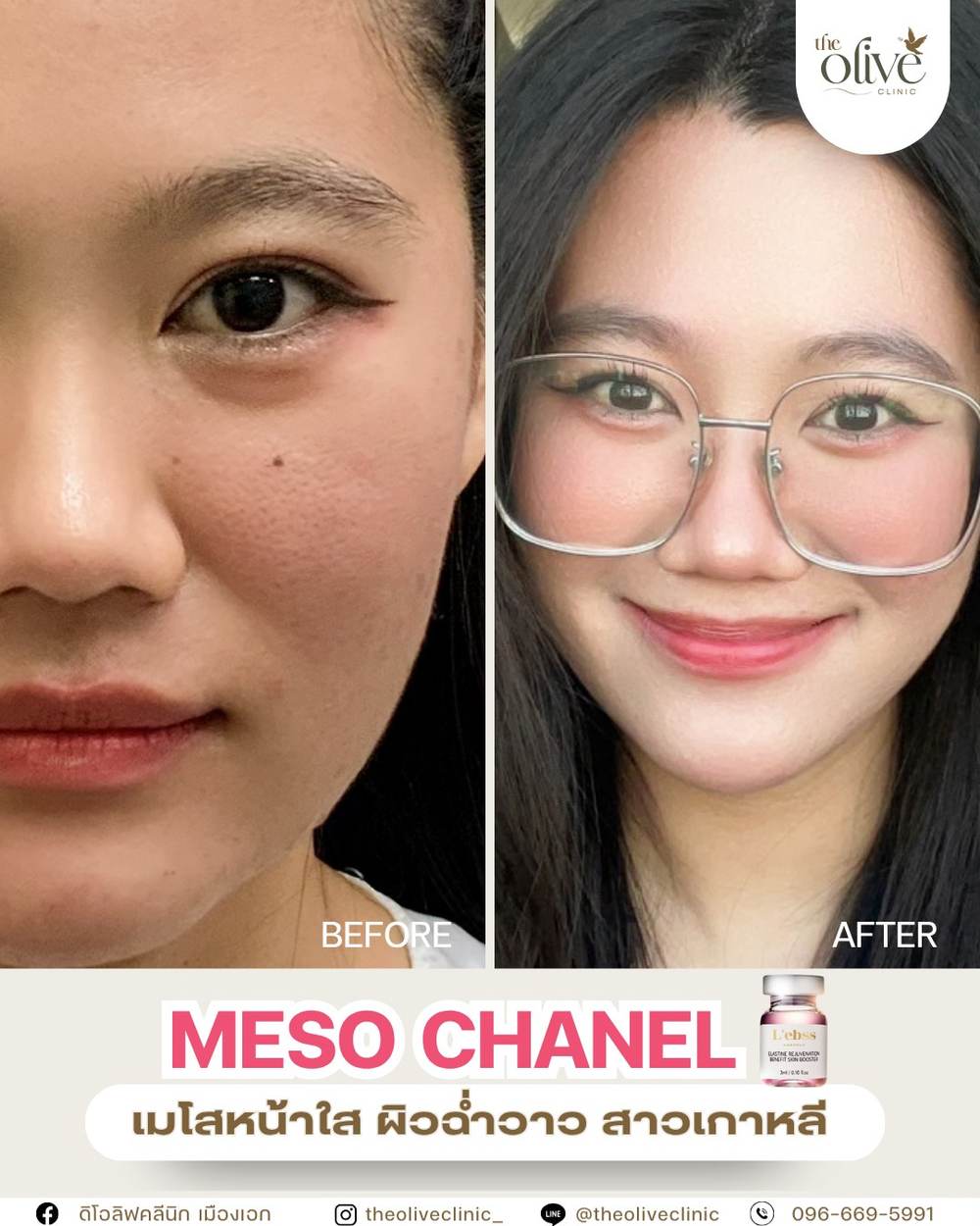 รีวิว Meso Chanel เมโสหน้าใส ผิวฉ่ำวาว The Olive Clinic