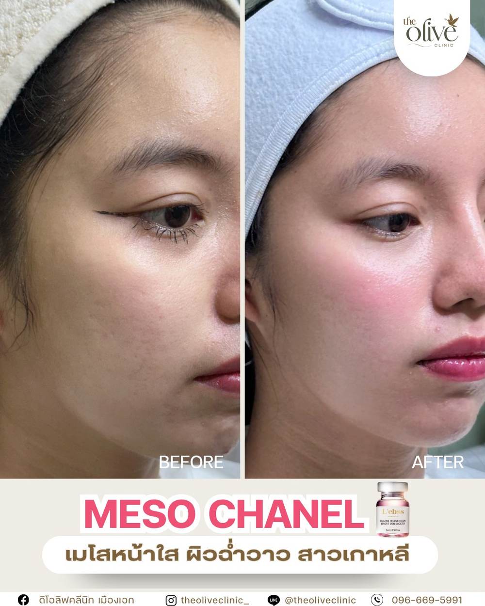 รีวิว Meso Chanel เมโสหน้าใส ผิวฉ่ำวาว The Olive Clinic