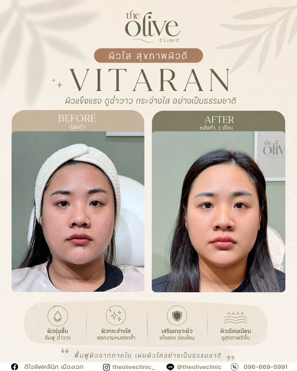 รีวิว Vitaran ผิวใส สุขภาพผิวดี The Olive Clinic