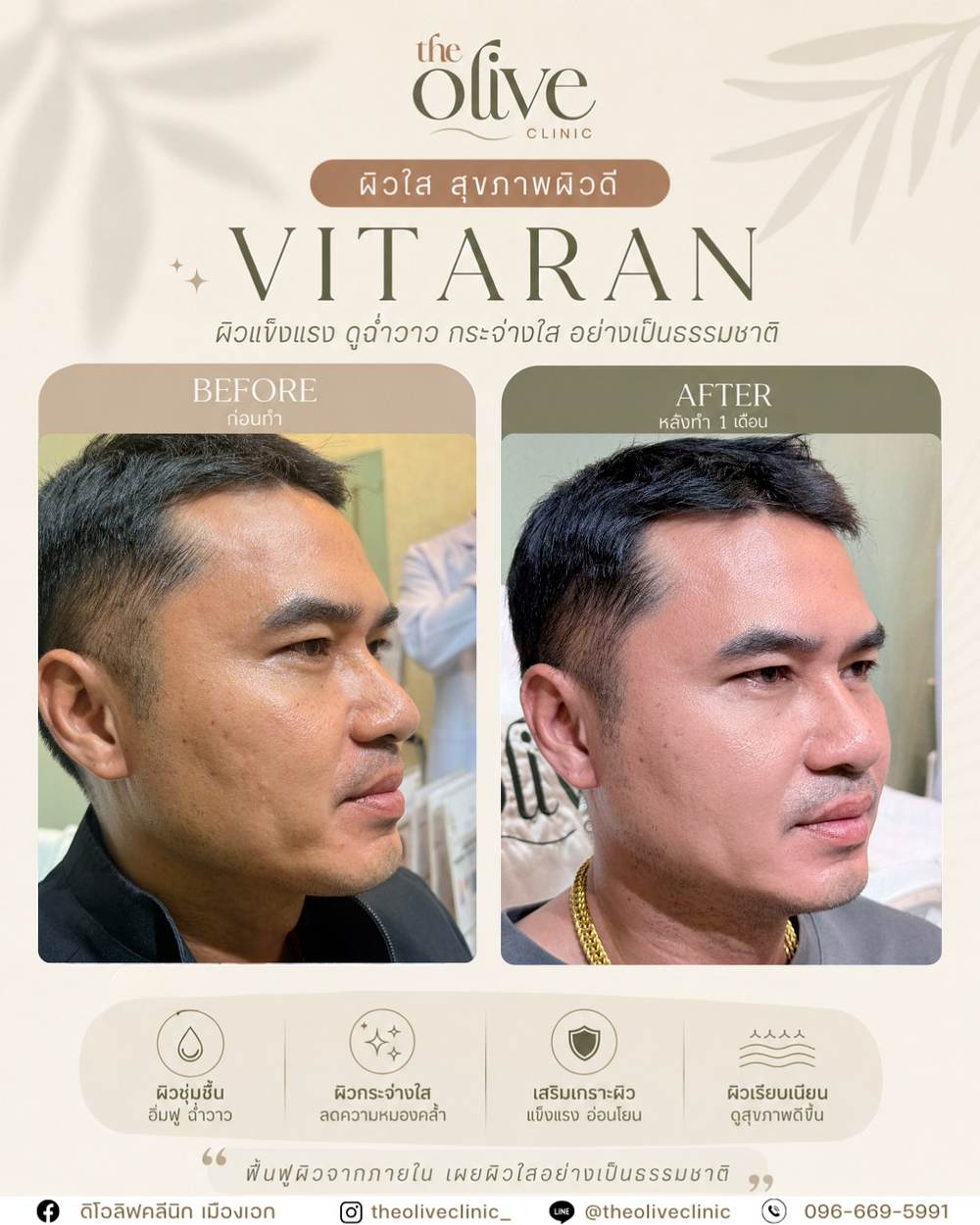 รีวิว Vitaran ผิวใส สุขภาพผิวดี The Olive Clinic