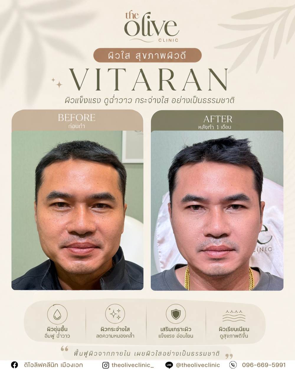 รีวิว Vitaran ผิวใส สุขภาพผิวดี The Olive Clinic