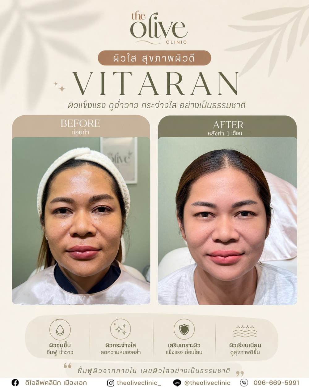 รีวิว Vitaran ผิวใส สุขภาพผิวดี The Olive Clinic